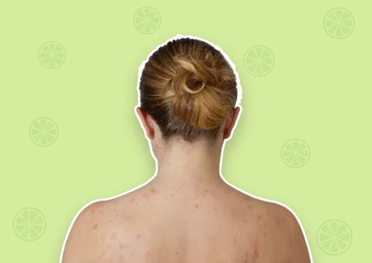 The Hidden Battle: Body Acne and Its Impact on Teenagers' Self-Confidence
