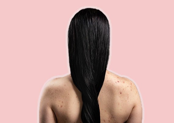 What Triggers Back Acne And How To Treat It?