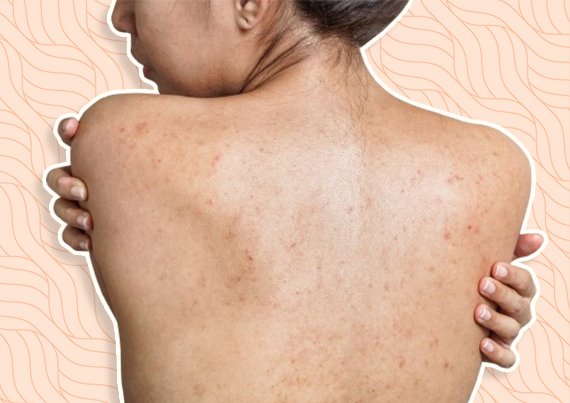 Seasonal Variations in Body Acne