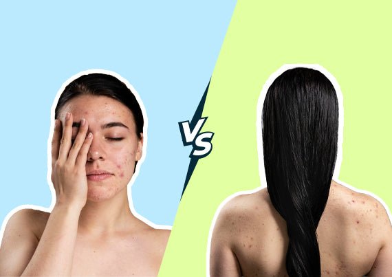 Face Vs. Body Acne - The Distinction