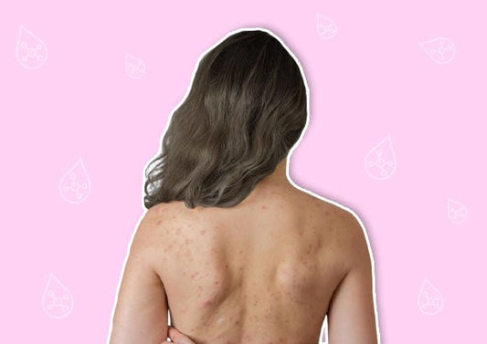 Retinol for Body Acne: Benefits, Side Effects, and How It Treats Body Acne